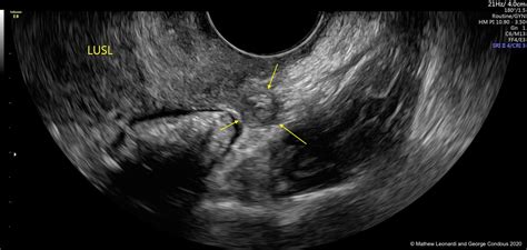 ultrasound features of endometriosis